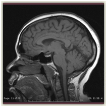 MRI